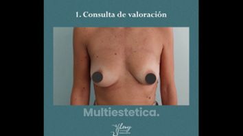 Mastopexia - Dr. Jhony Camarero