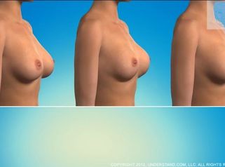 Mamoplastia de aumento