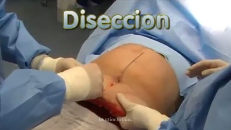 Así es una abdominoplastia