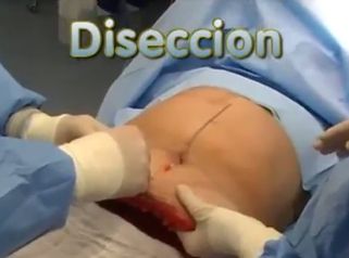 Así es una abdominoplastia