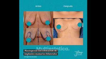 Mastopexia - Dr. Jhony Camarero