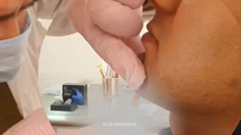 Marcaje Mandibular - Dr. Andrés Raúl Cortés Ponce