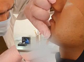 Marcaje Mandibular - Dr. Andrés Raúl Cortés Ponce