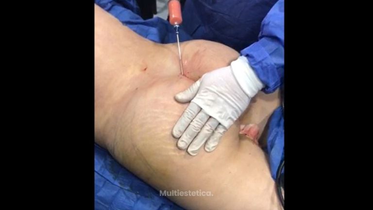 Gluteoplastia