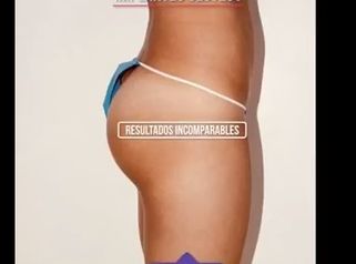 Implantes glúteos México