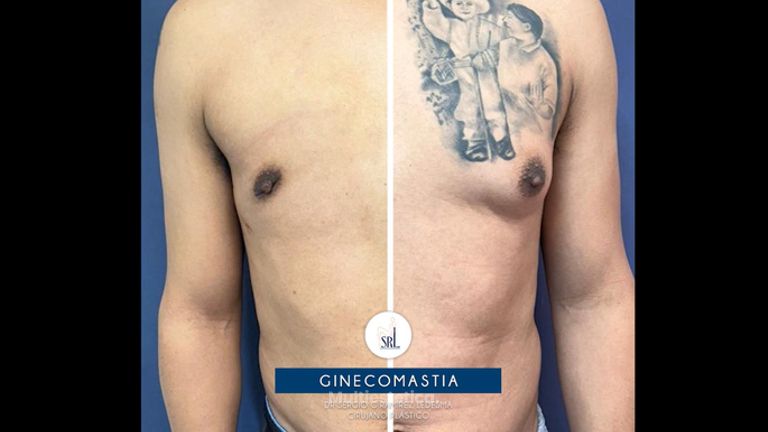 Cirugía ginecomastia - Dr Sergio Guillermo Ramírez Ledesma
