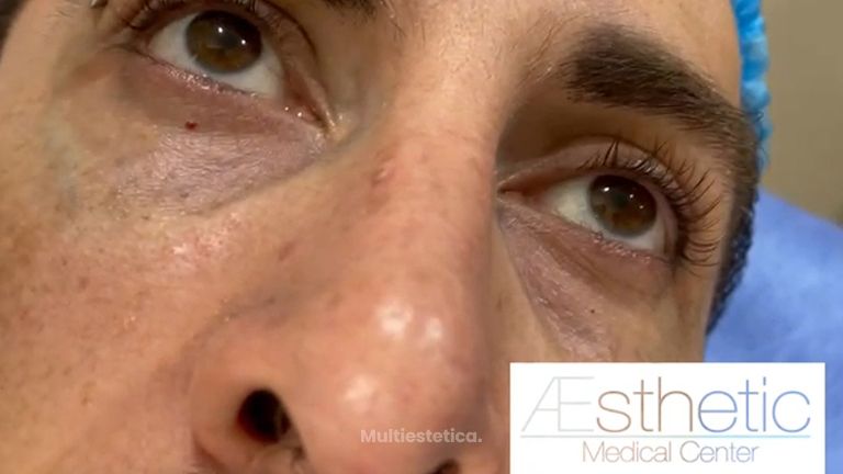 Eliminar ojeras - Dr. Sinué Orihuela García