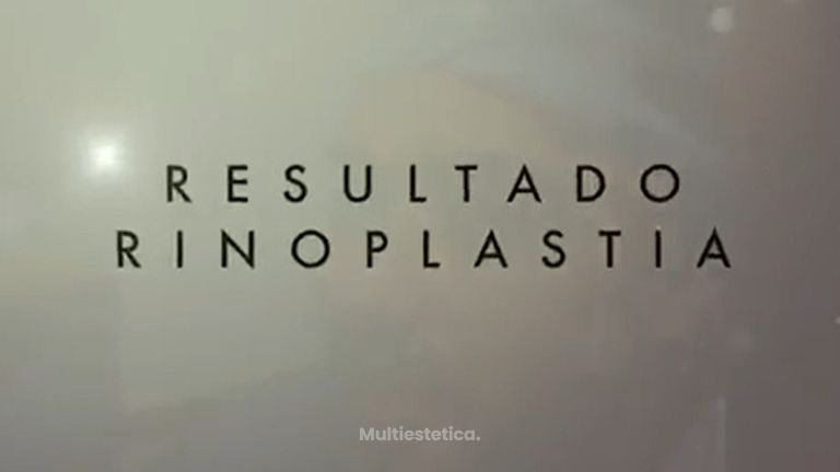 Testimonio rinoplastia