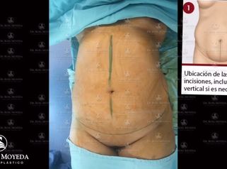 Tummy Tuck , Abdominoplastia o Lipectomia Dr Roel Moyeda