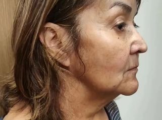 Lifting Facial - Dr. Alejandro Cruz Segura