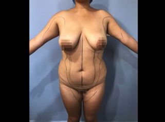 Lipoescultura - Dr. Christian Augusto Morales Orozco