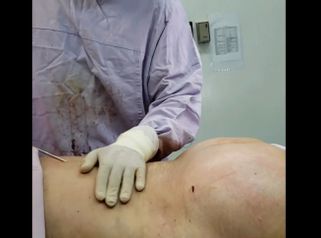 Lipoescultura con aumento de glúteos
