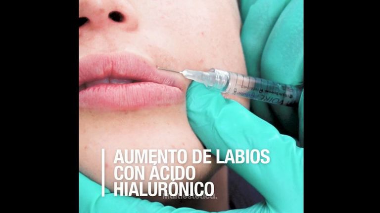 Aumento de labios con Ácido Hialurónico