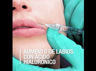 Aumento de labios con Ácido Hialurónico