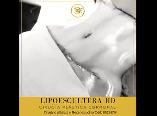 Lipoescultura - Dr. Ubaldo Carpinteyro Espín