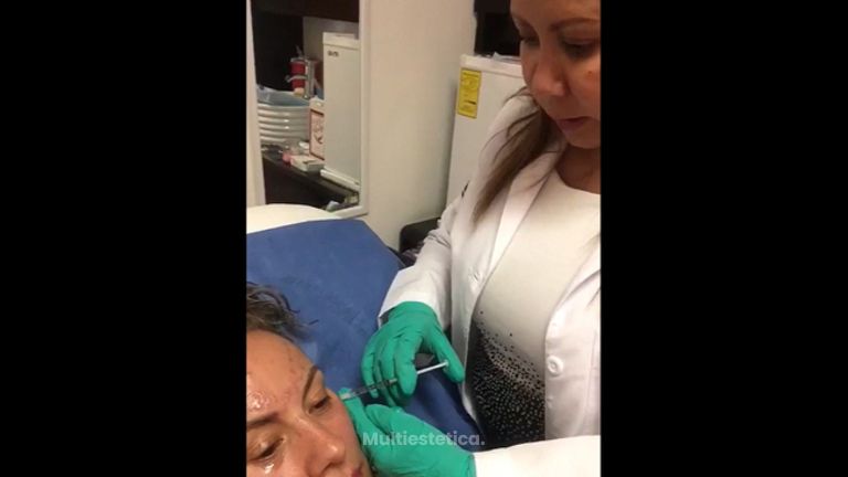 Tratando las patas de gallo con Toxina botulínica