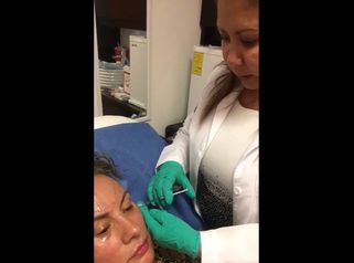 Tratando las patas de gallo con Toxina botulínica