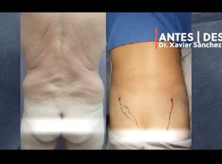 Liposucción - Dr. Xavier Antonio Sánchez García