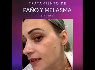 Tratamiento Paño y Melasma - Dra. Ionica Mihaela Dogaru