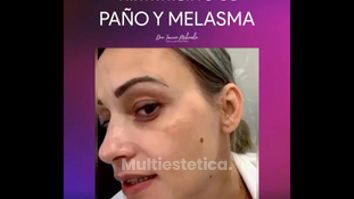 Tratamiento Paño y Melasma - Dra. Ionica Mihaela Dogaru