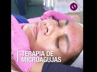 Terapia de microagujas