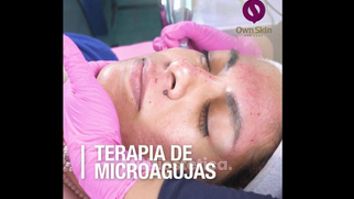 Terapia de microagujas