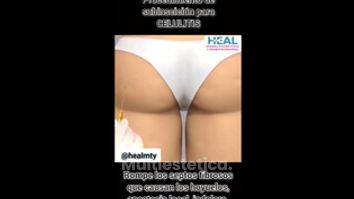 Tratamientos anticelulíticos - Clínica Heal Aesthetics