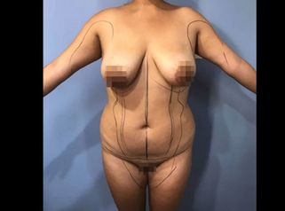 LIPOESCULTURA