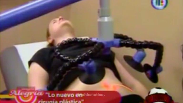 Haz una liposucción sin cirugía