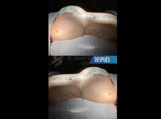 Gluteoplastia - Dr. Xavier Sánchez García