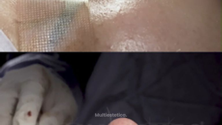 Rinoplastia - Dr. Lenin Alfonso Reyes Ibarra