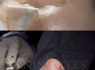 Rinoplastia - Dr. Lenin Alfonso Reyes Ibarra