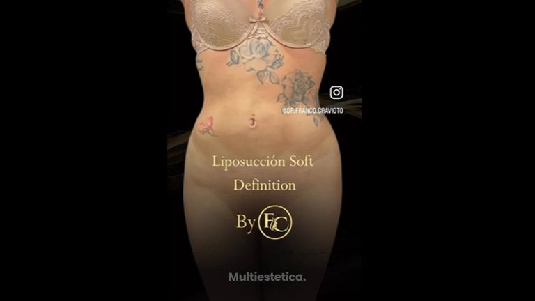 Liposucción - Dr. Franco Cravioto