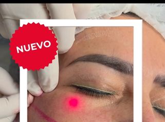 Endolifting Laser Parpados - Dra. Lorena Piña