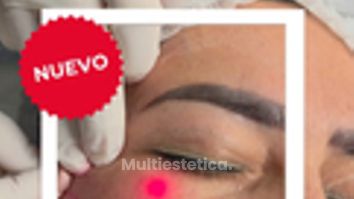 Endolifting Laser Parpados - Dra. Lorena Piña