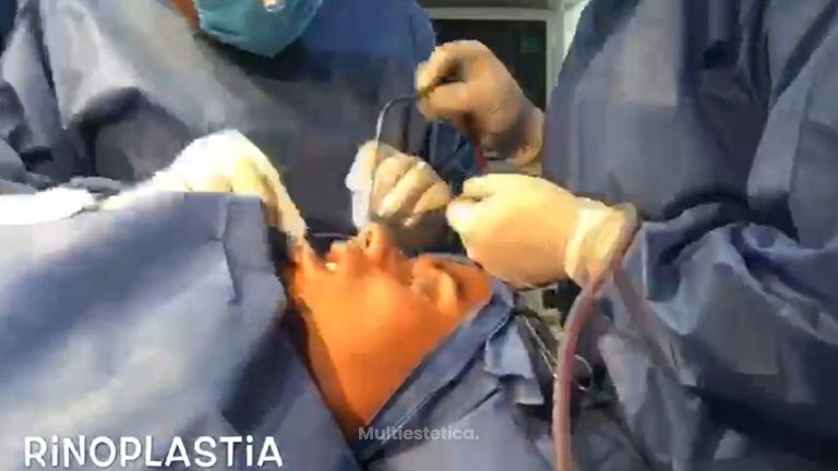 Rinoplastia