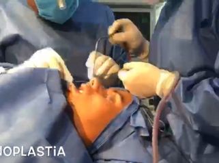 Rinoplastia