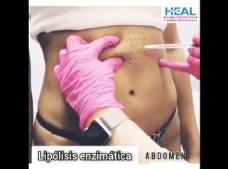 Lipólisis - Clínica Heal Aesthetics