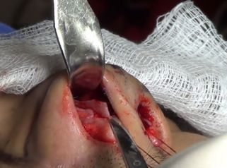 La mejor forma de reparar el dorso cartilaginoso