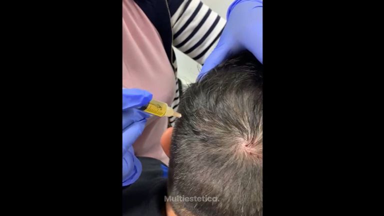 Trasplante de cabello - Dr. Jesús Omar Carreón Terrones
