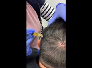 Trasplante de cabello - Dr. Jesús Omar Carreón Terrones