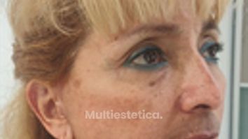 Lifting - Dr. Alejandro Cruz Segura