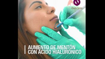 Aumento de mentón con Ácido Hialurónico