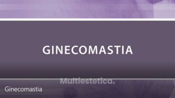 Ginecomastia