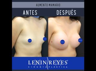 Aumento de busto