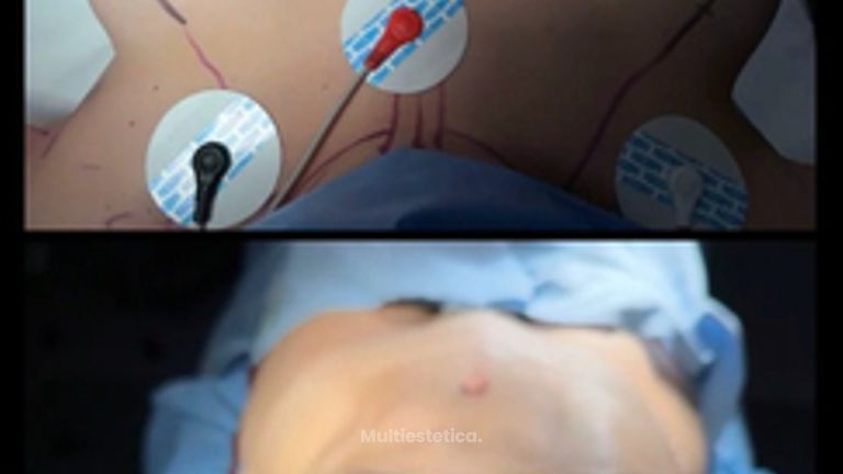 Mommy makeover - Dr. Rodrigo Camacho Acosta
