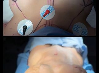 Mommy makeover - Dr. Rodrigo Camacho Acosta