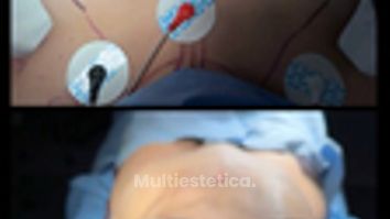 Mommy makeover - Dr. Rodrigo Camacho Acosta