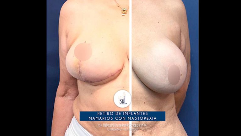 Reducción de mamas - Dr Sergio Guillermo Ramírez Ledesma
