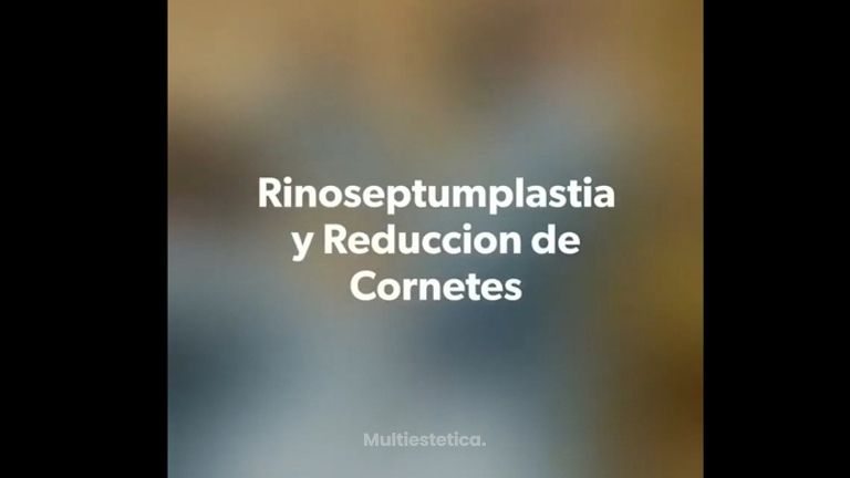 Rinoplastia - Fasent. Dr Rolando de la Garza Giacomán